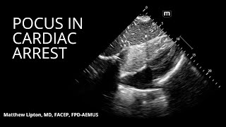 POCUS in cardiac arrest: A simple (yet evidence-based) algorithm
