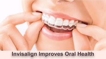 Top Benefits of Invisalign Clear Aligners
