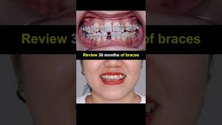 Review 30 months braces journey. Fix severely crowded teeth #braces #orthodontist #orthodontics