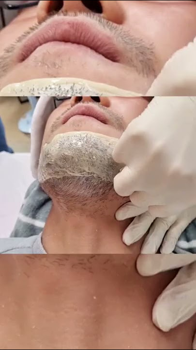 Beard Hair Pulling Hair Waxing Stress Relief Pleasure Skin Beauty Skin Care Men 수염왁싱 털뽑기 #shorts