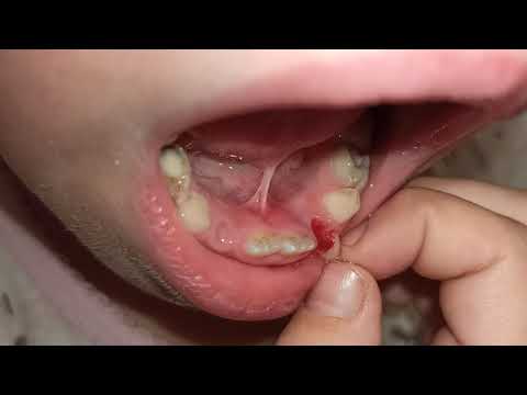 Ребёнок сам вырывает себе зуб