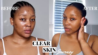 NIGHT-TIME SKINCARE | clearing my acne + dark spots with a Skin Cycling Routine