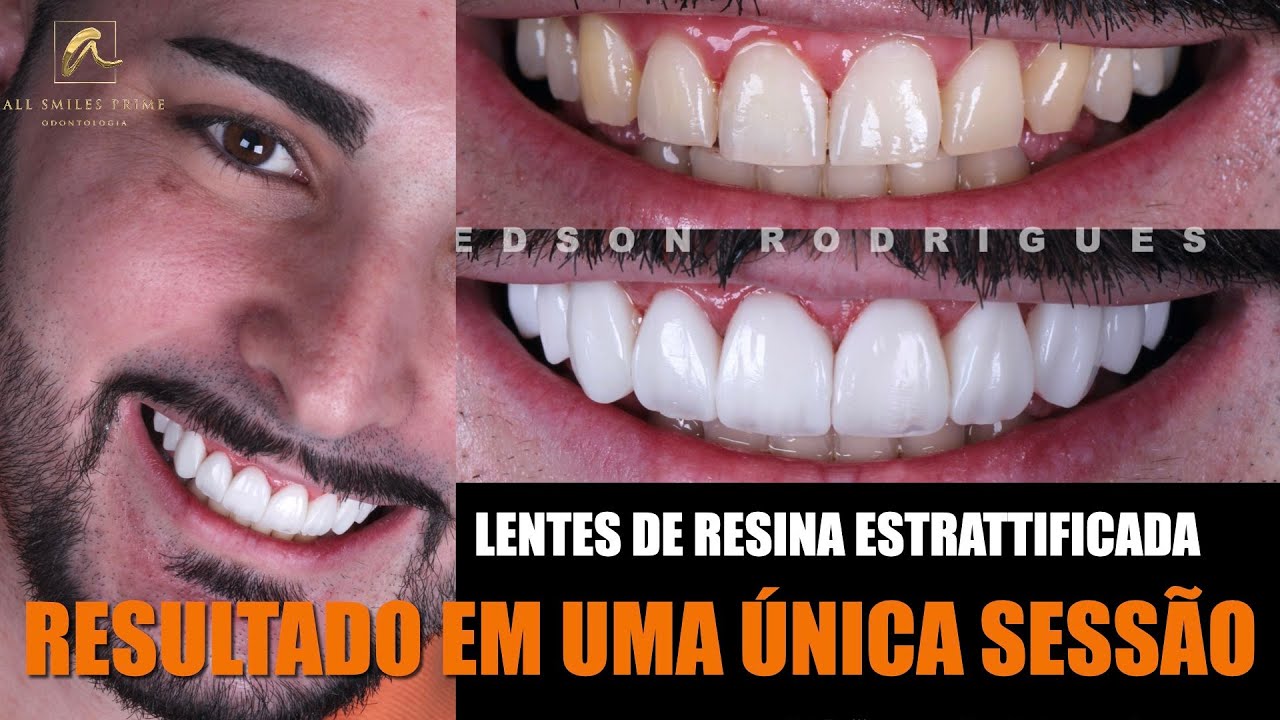 LENTES DE RESINA EM UMA SESSÃO!