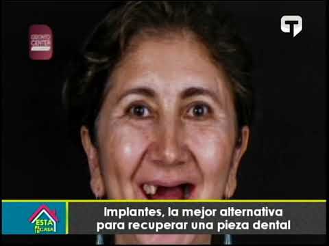 Implantes, la mejor alternativa para recuperar una pieza dental