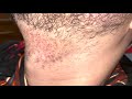 Dallas Beard Hair Transplant Close-Up