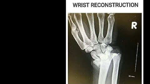 Wrist reconstruction||Intraarticular distal radius fracture||Wrist Anatomy||DRUJ Injury||Jess InDRUJ