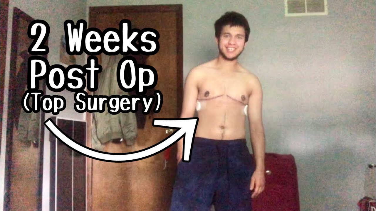2 Weeks Post Op Top Surgery//FTM TRANSGENDER YouTube