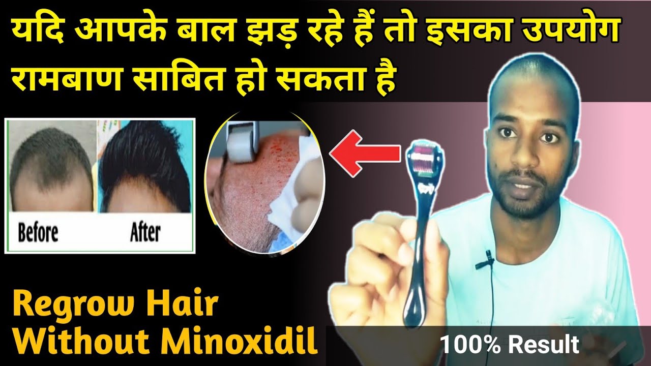 How to Regrow New Hair Without Minoxidil Hair Regrowth Tips Hair