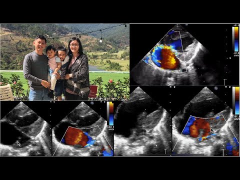 Video Túm lại ca kênh nhĩ thất kèm tâm thất độc nhất - youtube