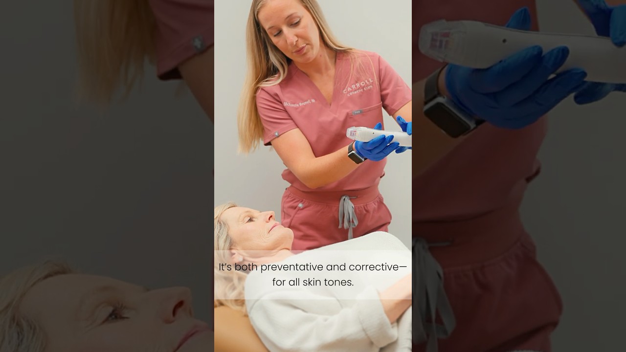 Virtue RF Microneedling at Carroll Cosmetic Club