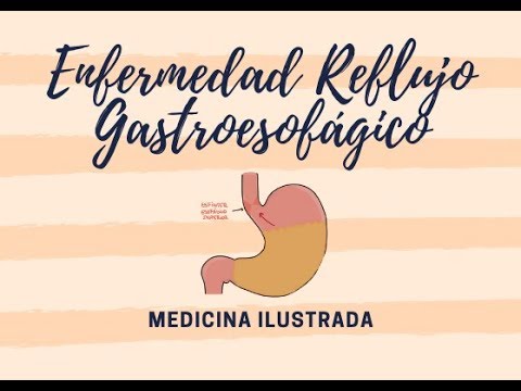 Vídeo: Enfermedad Por Reflujo Gastroesofágico: Síntomas, Tratamiento, Diagnóstico