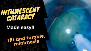 Case series 19. Intumescent cataract made easy! Tilt and chop, minirhexis, temporal topical phaco!