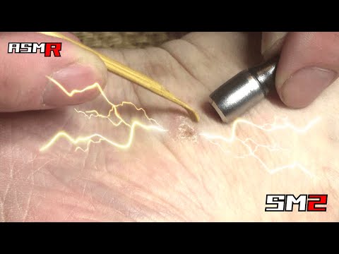 【眠くなるアトピー性皮膚炎ASMR】超痒い足首の硬いところを耳かきで掻く音/癒し/リラックス効果/睡眠導入/マッサージ