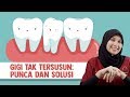 Gigi Tak Tersusun: Punca dan Solusi