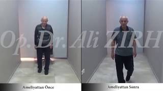 Hamza Bozkurt Parkinson Beyin Pili Ameliyatı Öncesi Ve 3 Hafta Sonrası