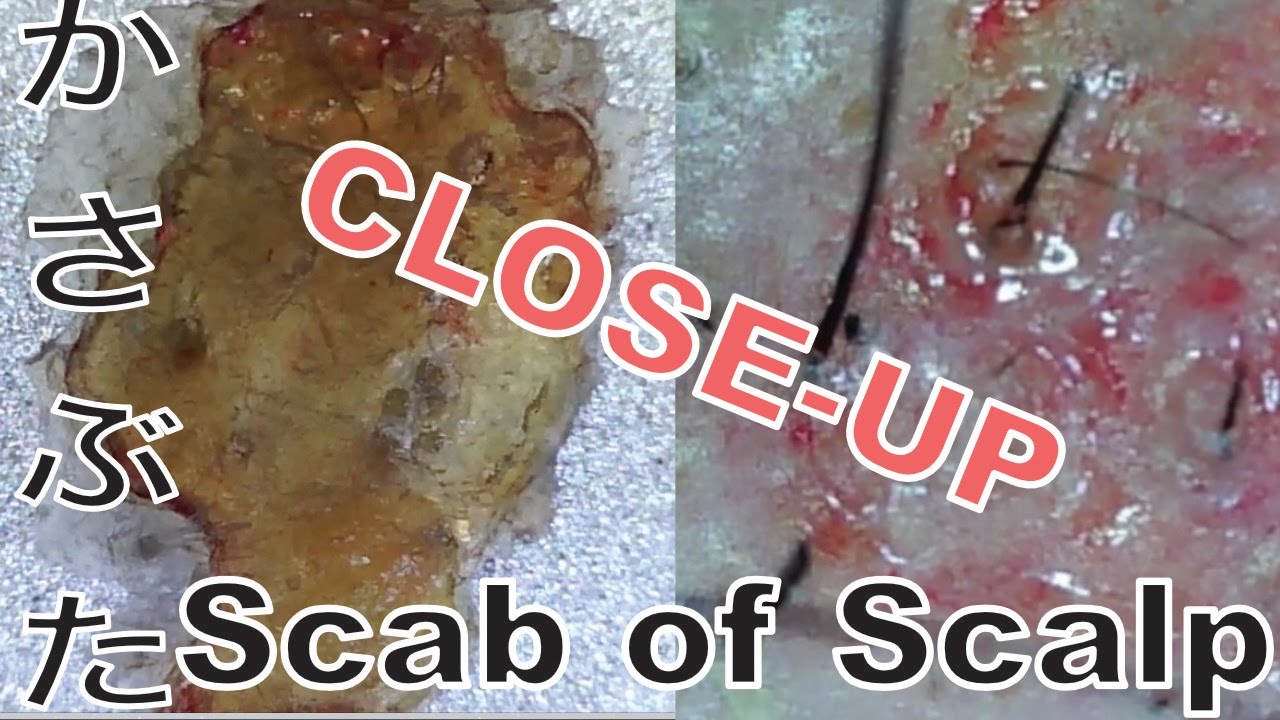 Scab Of Scalp Close Up Part 1 頭皮のかさぶたをはがして超接写 Youtube