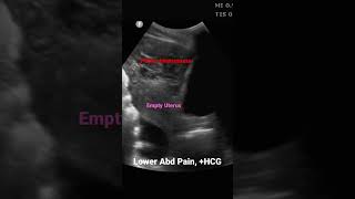 Ectopic Pregnancy #emergencymedicine #pocus #ultrasound #obgyn