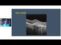 New treatments for wet AMD, Nigel Davies