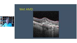 New treatments for wet AMD, Nigel Davies