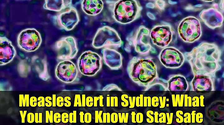 Measles Alert in Sydney: What You Need to Know to Stay Safe