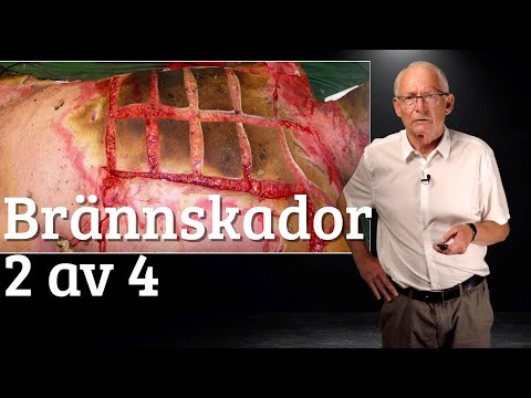 Brännskador 2 av 4