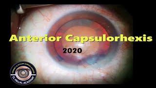 #001 Anterior capsulorhexis Lecture - basic