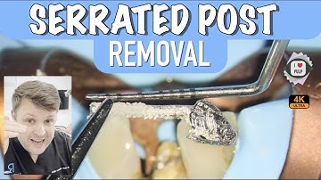 BEST WAY TO REMOVE SERRATED POST | 4K Resolution