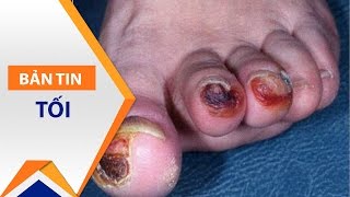 Báo động hoại tử bàn chân do đái tháo đường | VTC