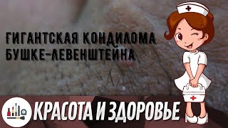 Гигантская кондилома Бушке-Левенштейна