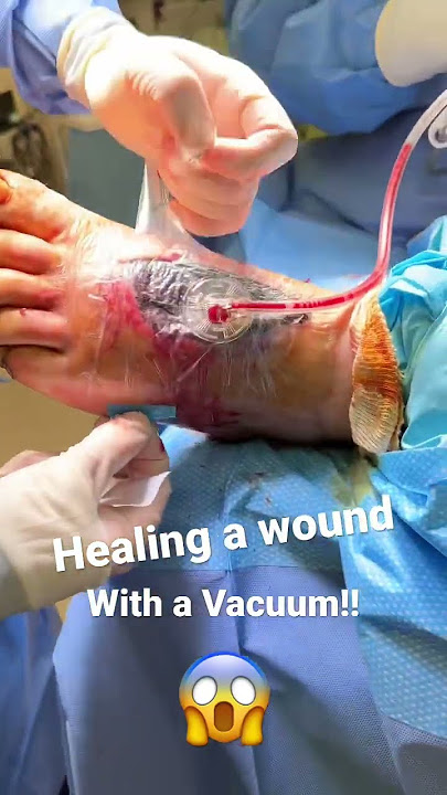 How wounds are healed!😱 #shorts