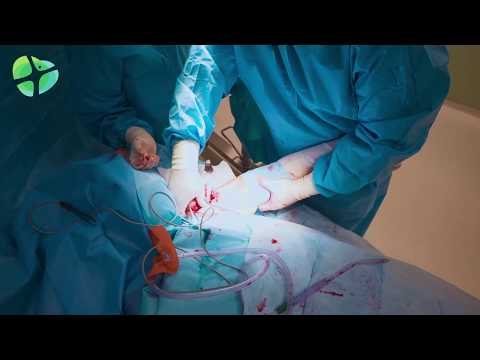 Wideo: Chirurgia ORIF: Otwarta Redukcyjna Stabilizacja Wewnętrzna Złamanych Kości