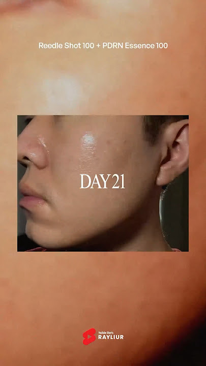 My 21 day results with VT REEDLE SHOT 100 #kbeauty