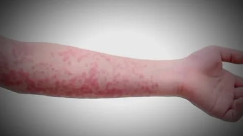 Measles cases in the US continue to rise after already reaching highest count in 30 years