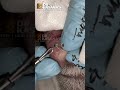 Nose Blackheads removal by dr lalit kasana