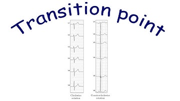 ECG basics: Transition point