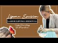 Large Lipoma Removal Simply Dermatology Dr Kally Papantoniou Large Lipoma Removal Simply Dermatology Dr Kally Papantoniou