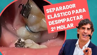 Separador elástico para desimpactar 2º molar!⚡️