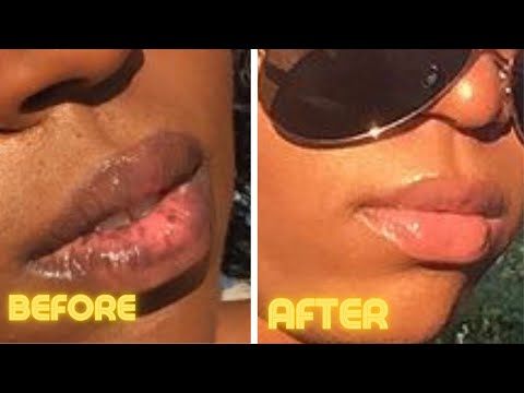 How I Treat My Lip Discoloration | 2021 Lip Routine To Save Money