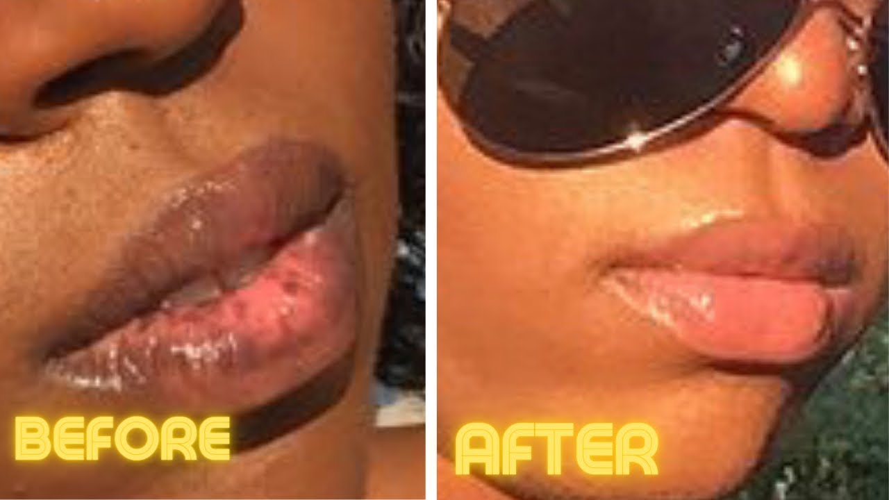 How I Treat My Lip Discoloration 2021 Lip Routine To Save Money YouTube How I Treat My Lip Discoloration 2021 Lip Routine To Save Money YouTube