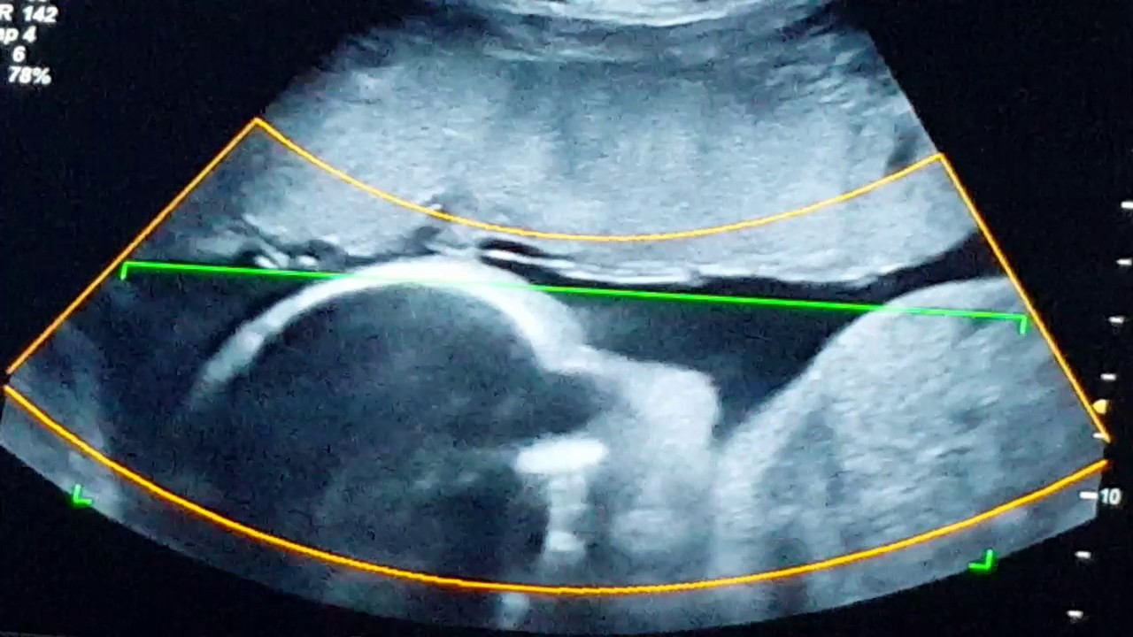 4D ultrasound at 28 weeks - YouTube
