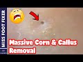 Massive Corn & Callus Removal Full Treatment By Miss Foot Fixer