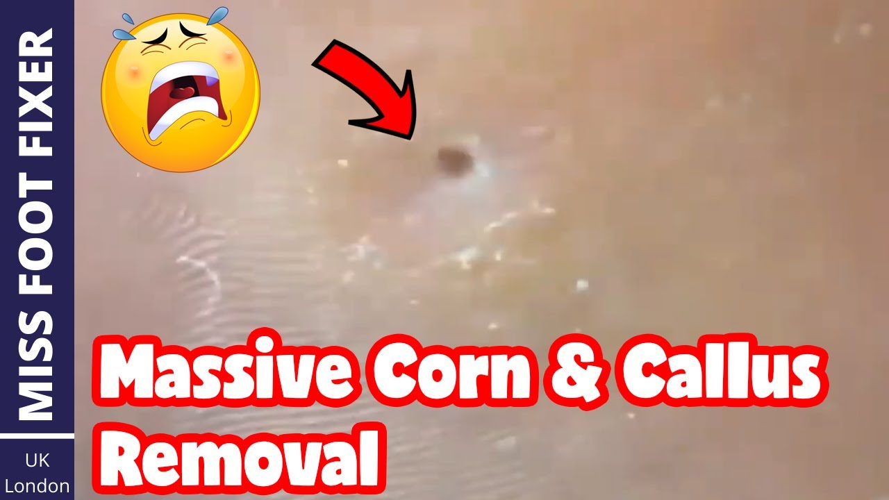 Massive Corn & Callus Removal Full Treatment By Miss Foot Fixer YouTube