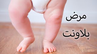 مرض بلاونت - Blount’s disease