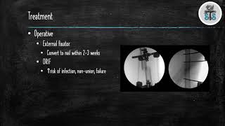 Femoral Shaft Fractures