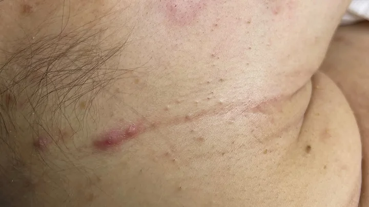 Relaxing Acne Treatment #187(Linh My Dang)