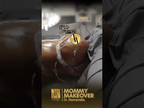 Mommy makeover before and after video by Dr. Mameniskis