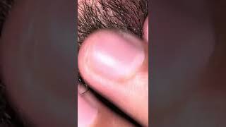 ASMR ingrown hair massage 💆 hair cut hair removal hair therapy 