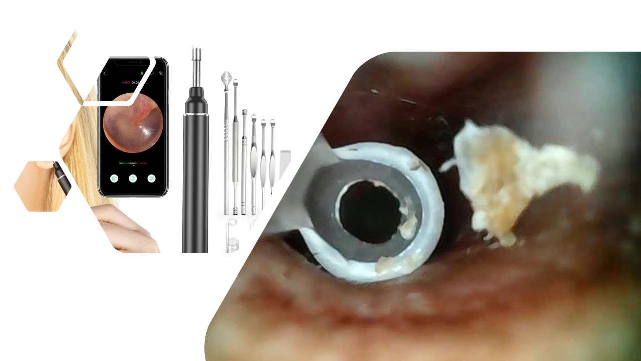VITCOCO Otoscope Safe alternative to Cotton Buds using YouTube