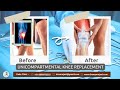 Patients before and after unicompartmental knee replacement surgery  dr amyn rajani  oaks clinic