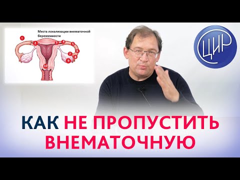 Видео: На каком раннем сроке можно выявить внематочную беременность?